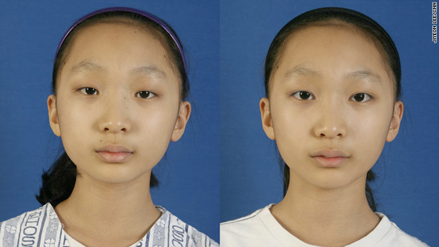 Cosmetic Surgery Asian 41