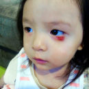Chalazion aerin_chalazion_4