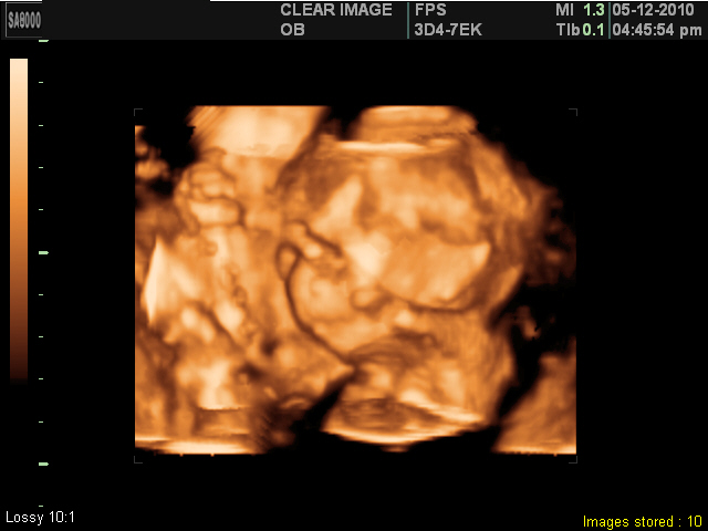 3D Ultrasound Pictures!
